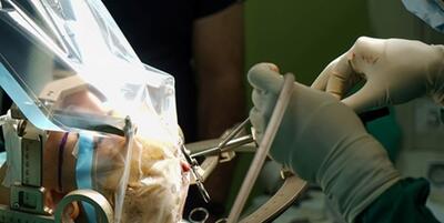 خبرگزاری فارس - نخستین جراحی کاشت الکترود در مغز برای درمان صرع