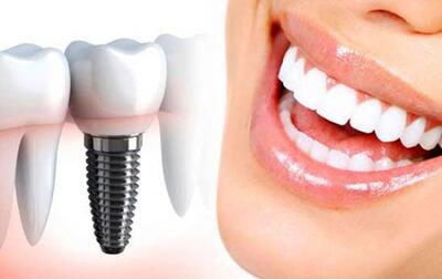 ویژگی‌های ایمپلنت دندان خوب و با کیفیت