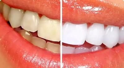 سفیدکردن دندانهای زرد به همین راحتی است