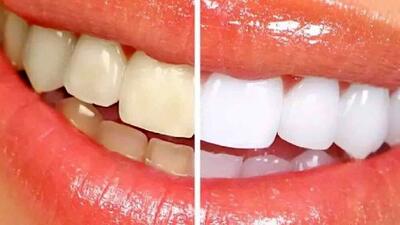 سفید کردن دندان‌ ها در خانه با چند روش ساده