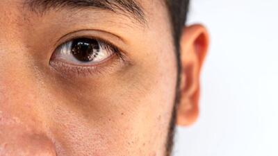 علل ورم صورت و التهاب زیر چشم