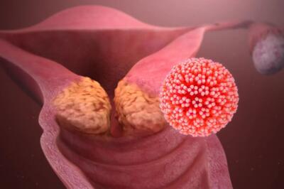 HPV و افزایش خطر بیماری قلبی در زنان
