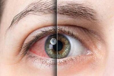 روغن کرچک برای درمان خشکی چشم موثر است؟