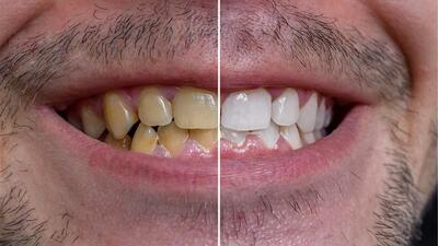 ترفندهای اساسی برای سفیدشدن دندان‌های زرد