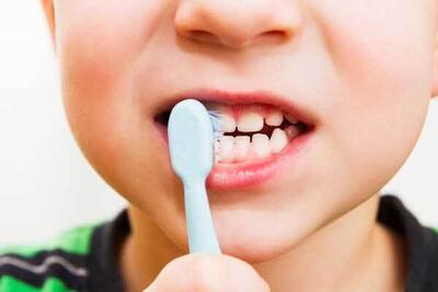 علائم اولیه پوسیدگی دندان در کودکان