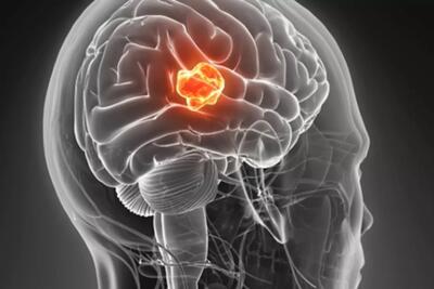 درمان تومور مغزی بیمار ١٣ ساله برای اولین‌بار در جهان