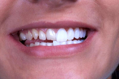 بهترین دندانپزشک زیبایی کامپوزیت ونیر کیست؟