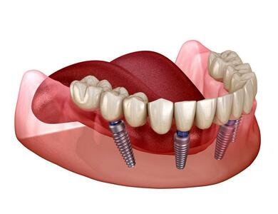ایمپلنت تخصصی دندان و انواع آن