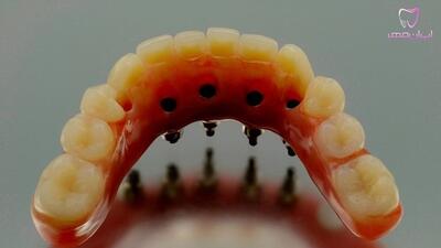 ایمپلنت دندان: عوارض احتمالی و راه‌های پیشگیری