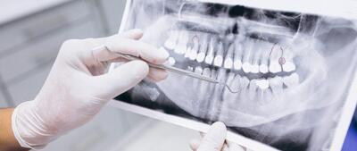آمار فاجعه‌بار پوسیدگی دندان در بزرگسالان