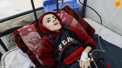 (تصاویر) سوءتغذیه تکان‌دهنده کودک فلسطینی در غزه