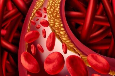 علائم چربی خون بالا چیست؟