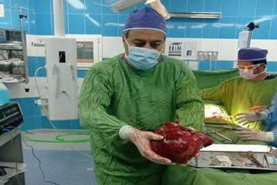 در یک عمل نادر جراحی، تومور ۳.۵ کیلویی از کلیه یک بیمار خارج شد +عکس
