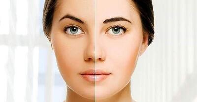 ۶ راه خانگی برای سفید شدن پوست صورت