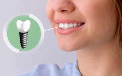 بهترین فاصله زمانی بین کشیدن دندان و کاشت ایمپلنت چقدر است؟