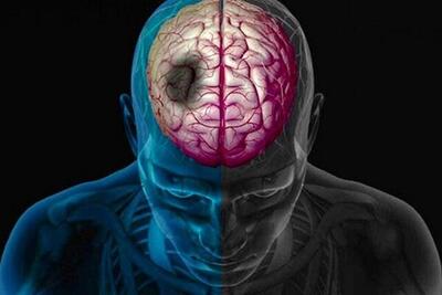 چگونه می‌توان از بروز سکته مغزی جلوگیری کرد؟