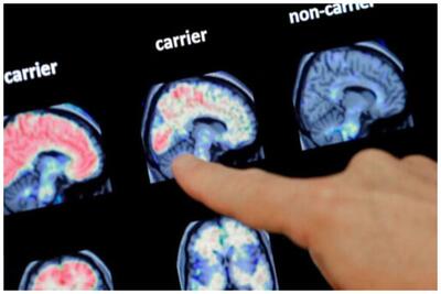 یک نظر جدید درباره منشا بیماری آلزایمر