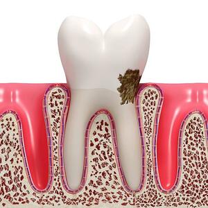 برای سلامت ریشه دندان این دو کار فراموش نشود | درد دندان در گرما و سرما را جدی بگیرید