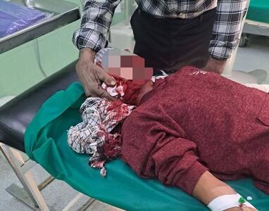 پسر ۱۴ ساله راوری، اولین مصدوم چهارشنبه‌سوری در استان کرمان 