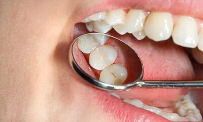 مردم با این گرانی‌ها قید سلامت دندان را زدند