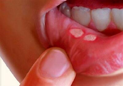 درمان آفت دهان به کمک طب سنتی