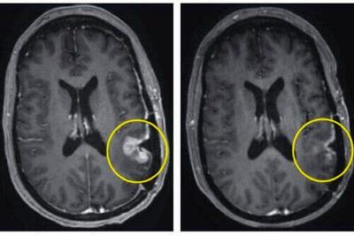 درمان باورنکردنی تومور مغزی تنها در 5 روز !