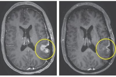 یک درمان جدید تومور مغزی را ظرف ۵ روز از بین برد