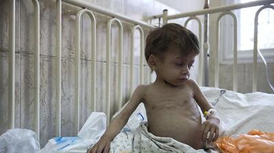 آنروا از شیوع بی‌رویه سوءتغذیه در بین کودکان غزه خبر داد