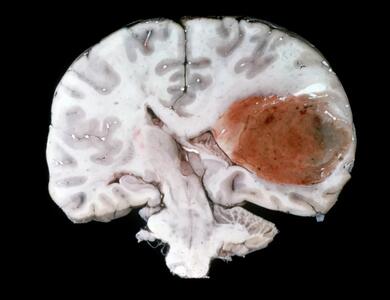 درمان جدید سرطان، اندازه یک تومور مغزی کشنده را در عرض چند روز کاهش داد