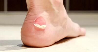 راهکار‌هایی برای جلوگیری از تاول زدن پا