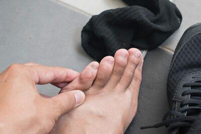 راهکار‌هایی برای جلوگیری از تاول زدن پا