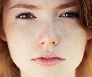 درمان لک های پوست با چند ترکیب ساده