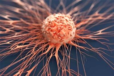 علائم مهم این سرطان گوارشی شایع چیست؟ | اقتصاد24