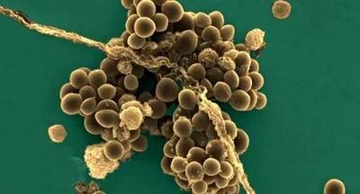 علائم مسمومیت غذایی با باکتری استافیلوکوکوس اورئوس