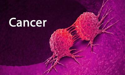 انتشار جدول جهانی شیوع سرطان‌ها در کشورها/ ایران به کدام نوع از سرطان شناخته شده است؟