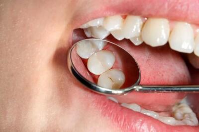 کاهش پوسیدگی‌های دندان با کنترل مصرف قند