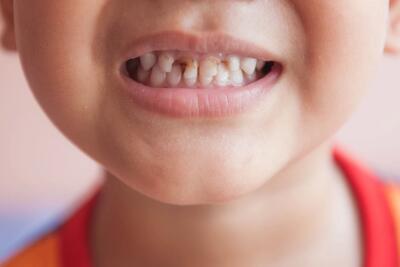 آنچه باید درباره تاخیر در رویش دندان های دائمی کودکان بدانید