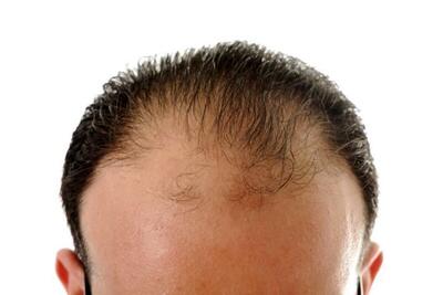 دلایل اصلی ریزش مو در افراد