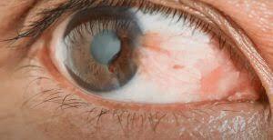 درباره انواع بیماری‌های شایع چشمی چه می‌دانید؟