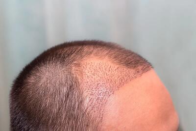 نحوه و درمان جوش کف سر بعد از کاشت مو