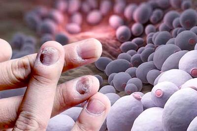 آیا می دانستید عفونت قارچی کشنده‌تر از سرطان و مالاریا است؟
