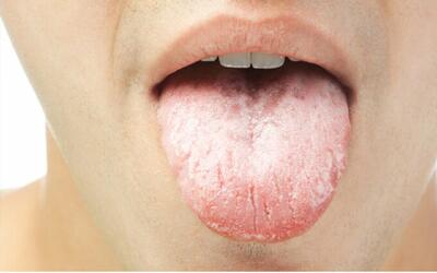 راهکارهای موثر برای درمان خشکی دهان