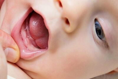 اگر دندان‌های نوزادتان جوانه زده به واحدهای بهداشتی مراجعه کنید