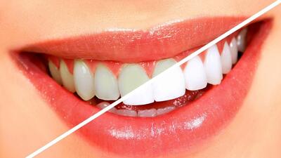4  روش خانگی برای سفید کردن دندان‌های زرد!
