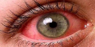 علت قرمزی چشم چیست؟ (بررسی جامع + درمان خانگی + پزشکی) - چی بپوشم