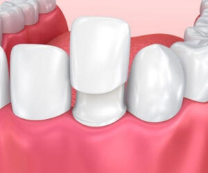 آیا لمینت دندان دائمی است؟