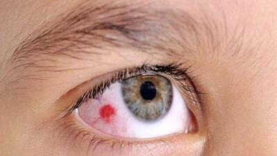 سرطان چشم ، بیماری که بیشتردر کمین چشم رنگی هاست!
