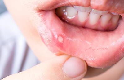 درمان آفت دهان در سریع ترین زمان ممکن در خانه!