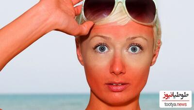 روش های موثر برای سفید کردن پوست آفتاب سوخته