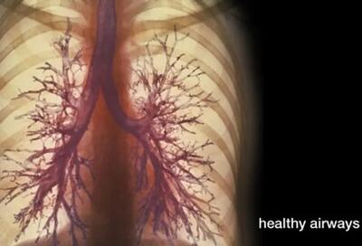 COPD چیست؟علائم ریه، تشخیص، درمان آن! - اندیشه معاصر